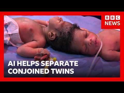 AI Aids in Separation of Conjoined Twins | BBC News