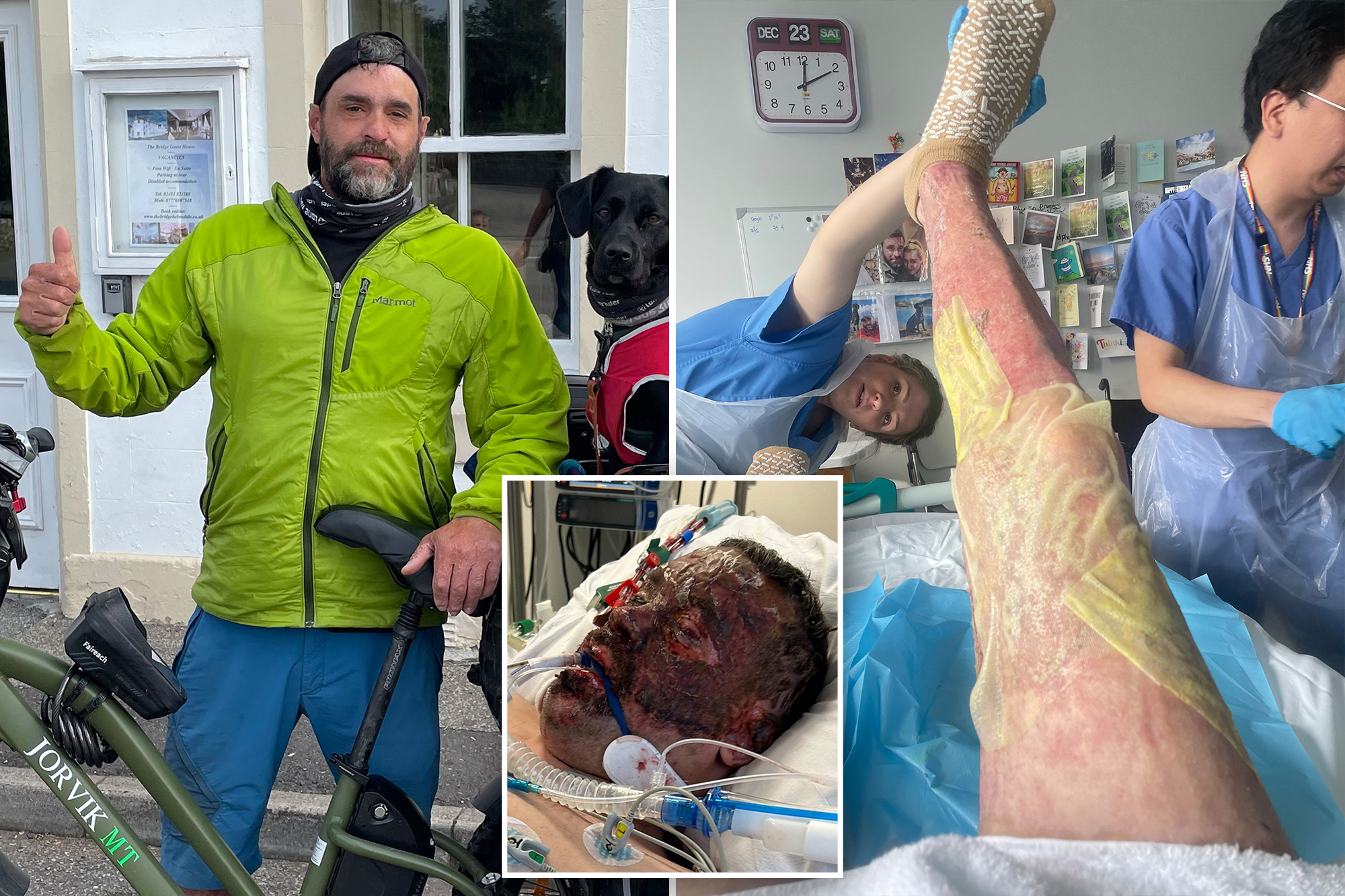 Dad Survives Coma After Distillery Explosion