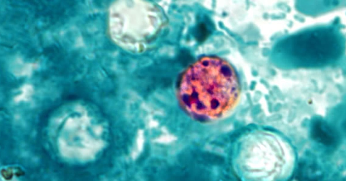 86 people have been hospitalized with the foodborne parasite spreading across the U.S., the CDC said
