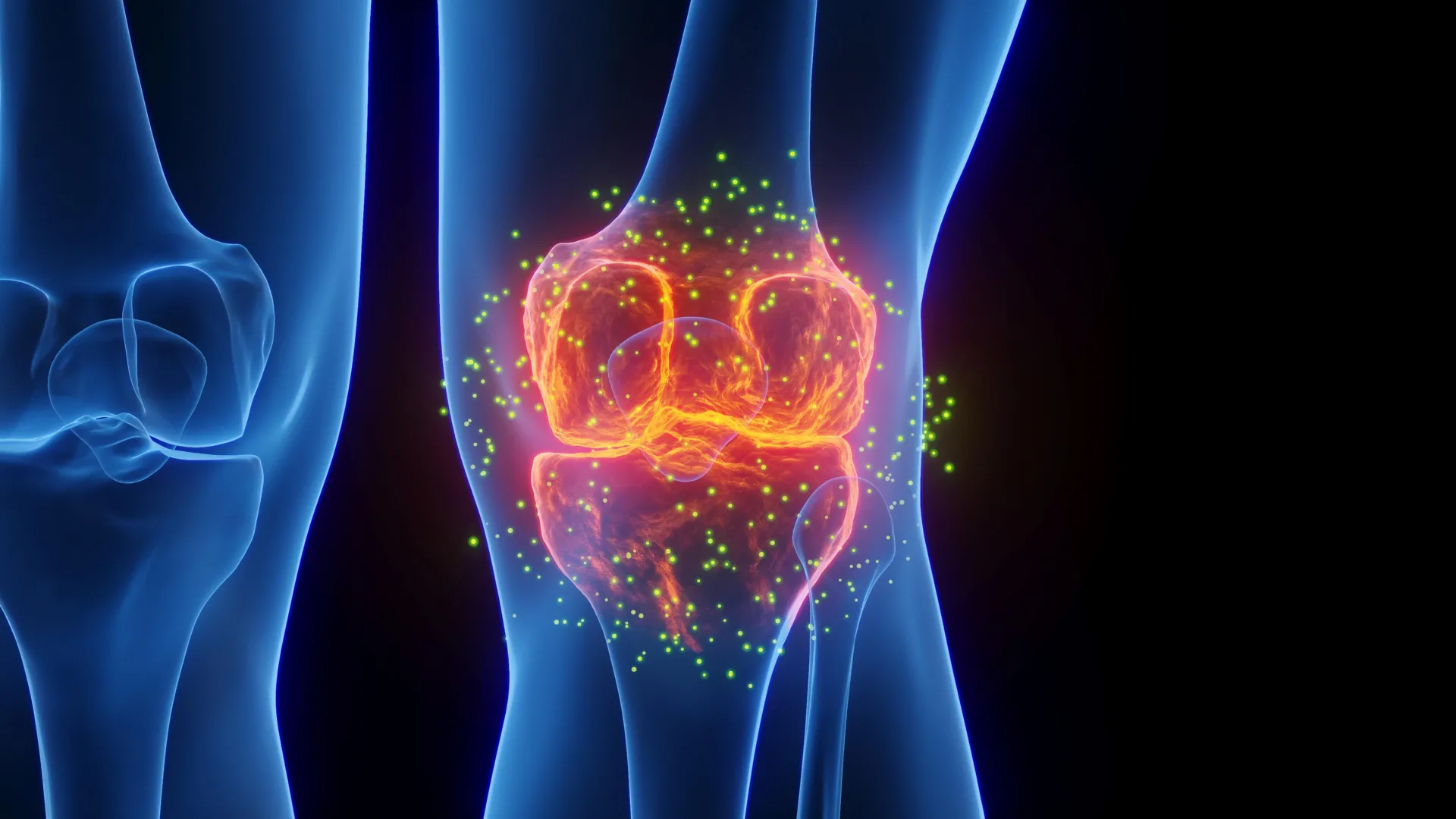 This ultrasound treatment may help stop arthritis before it starts