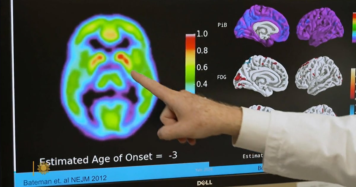 Alzheimer's blood test may show who's likely to develop it in 5 to 10 years