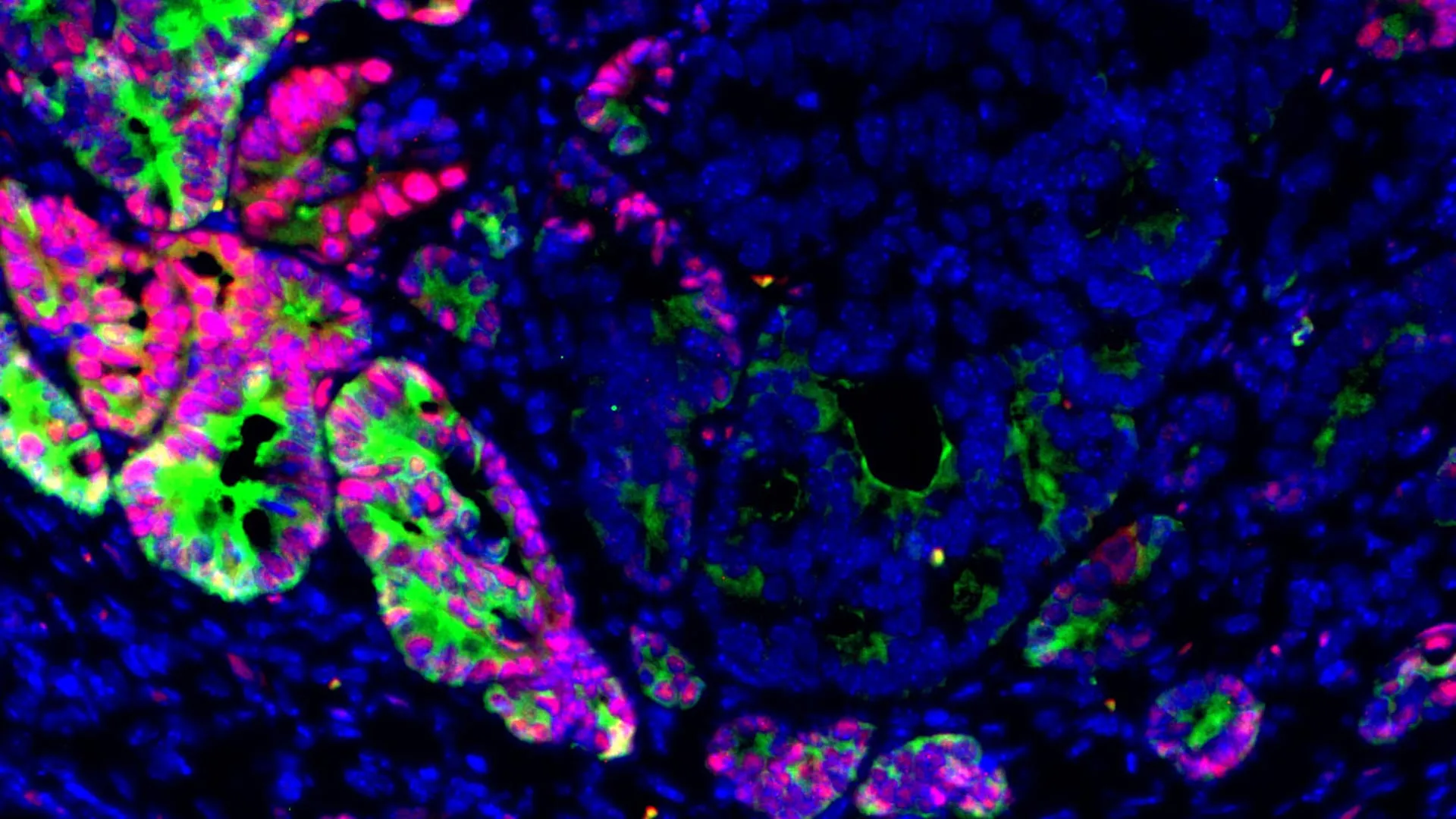 Scientists discover how colon cancer cells change identity to spread