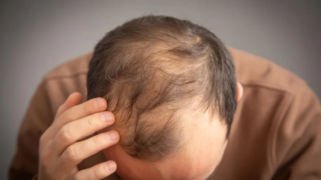 Ozempic and Wegovy may raise hair loss risk in some men