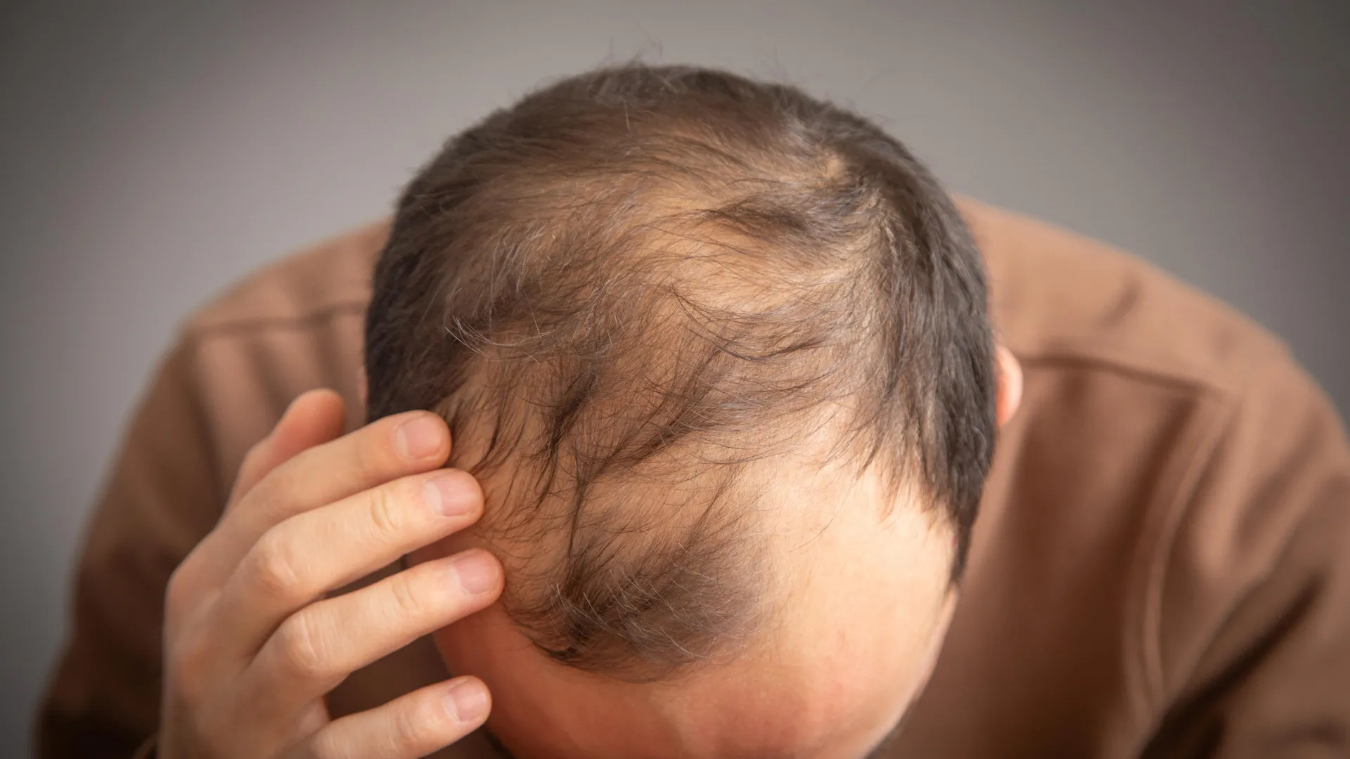 Ozempic and Wegovy may raise hair loss risk in some men