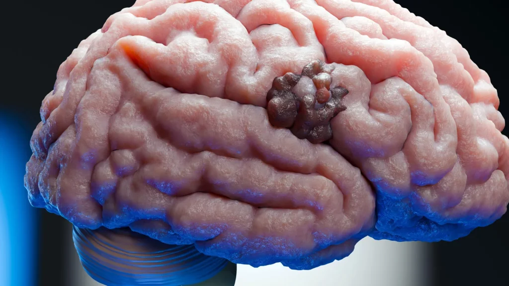 Scientists find a weak spot in one of the deadliest brain cancers
