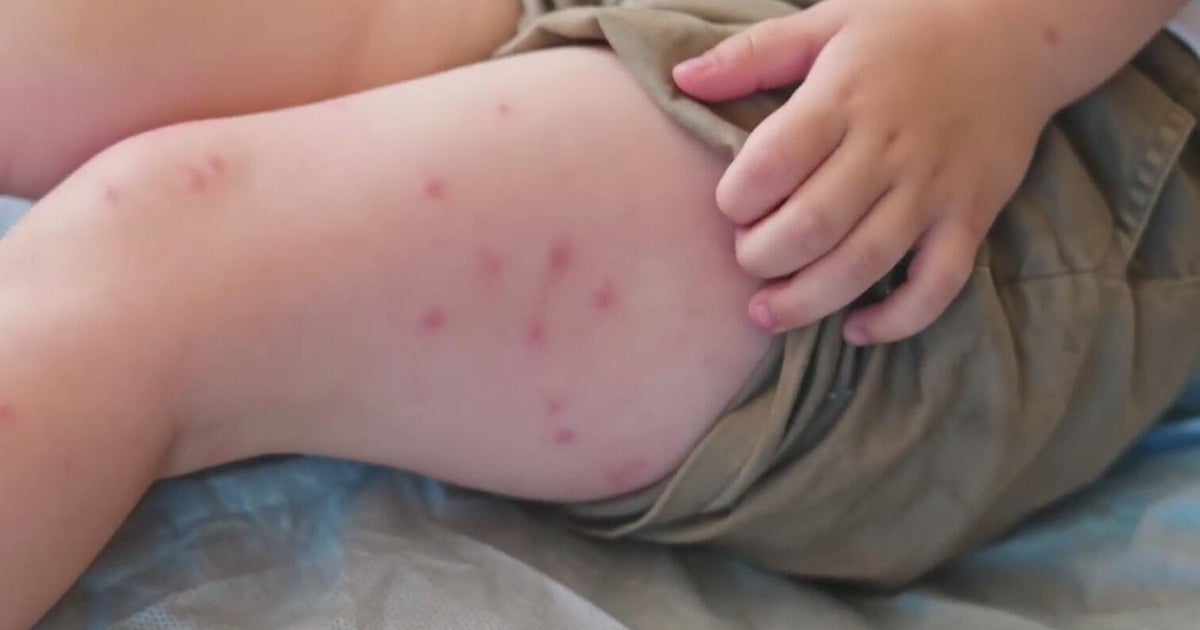 Dallas County measles case prompts North Texas exposure warning – cbsnews.com