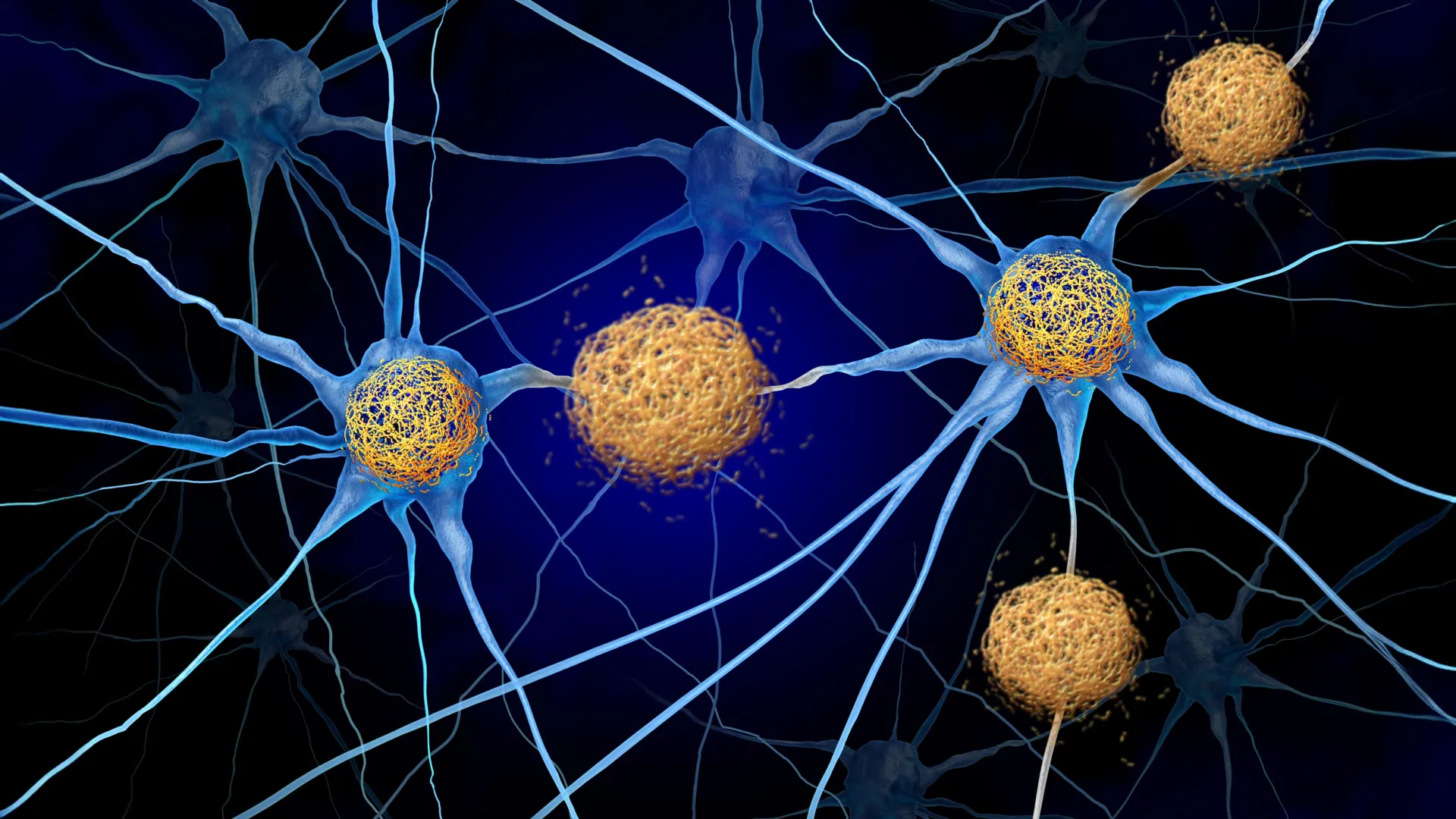 Alzheimer’s may leave a mark on the brain long before plaques appear