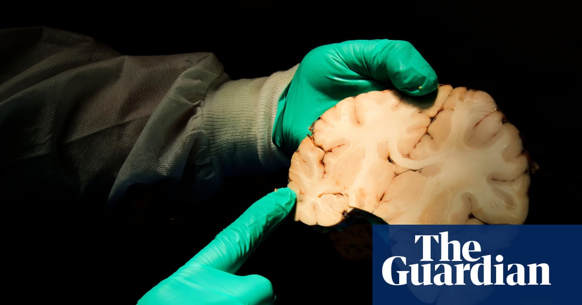 New study estimates 75% of deceased ex-NFL players had brain disease CTE