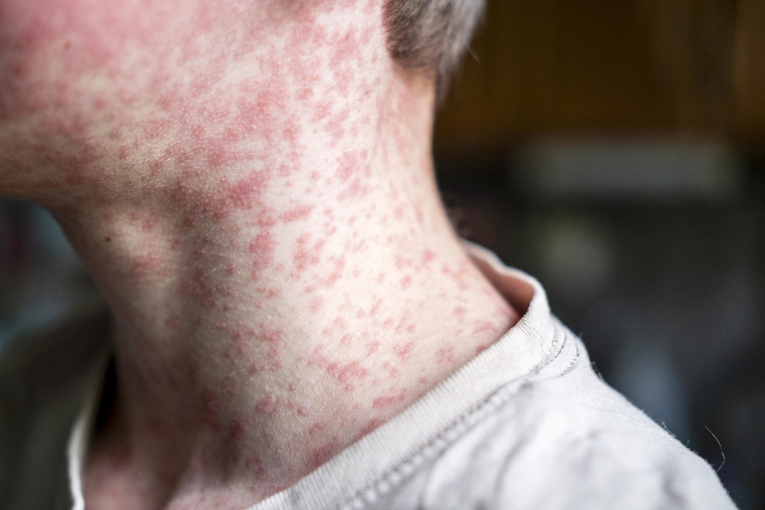 US Measles Cases Top 4,000, CDC Reports Infections In 45 States – iHeart