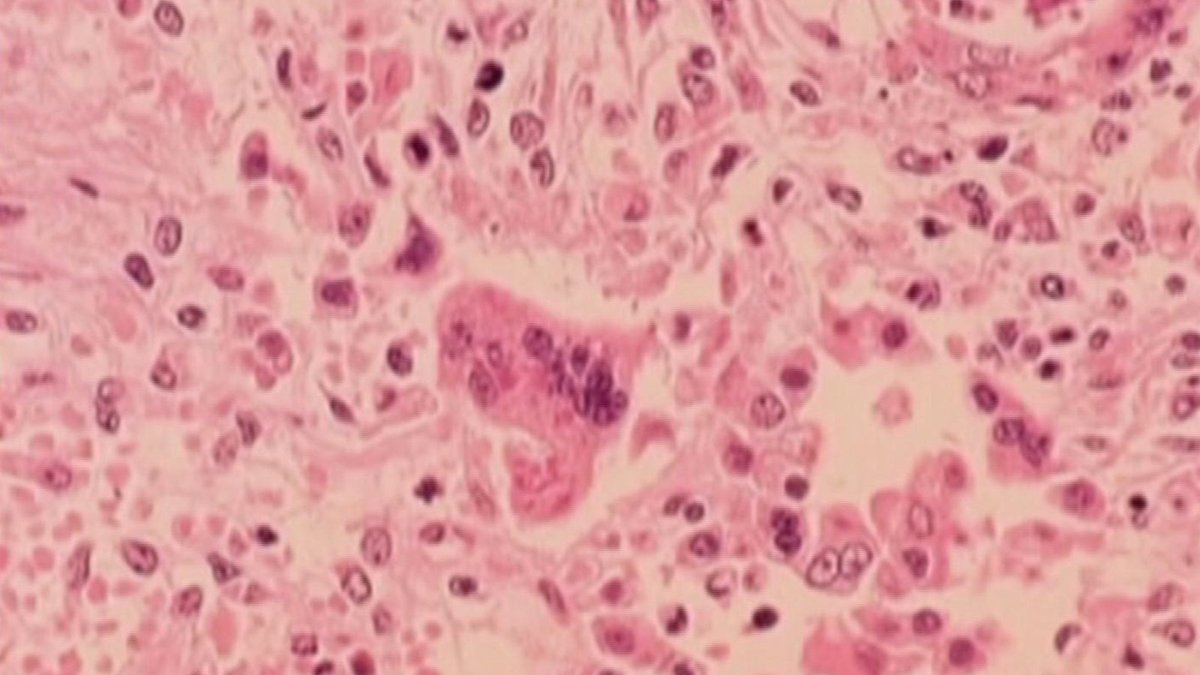 Pennsylvania records 6th measles-associated death this year, officials say – NBC10 Philadelphia