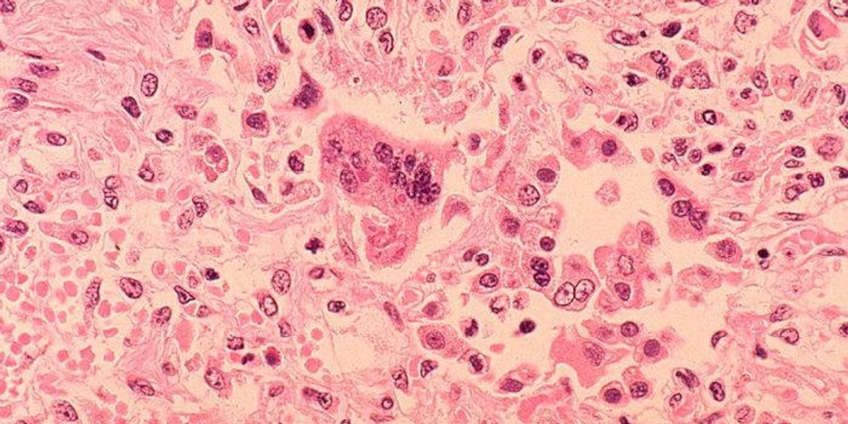 Pa. warns of measles infections among pregnant women and congenital cases – Audacy